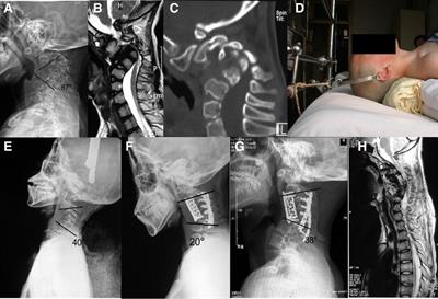 Effect of cervical suspensory traction in the treatment of severe cervical kyphotic deformity